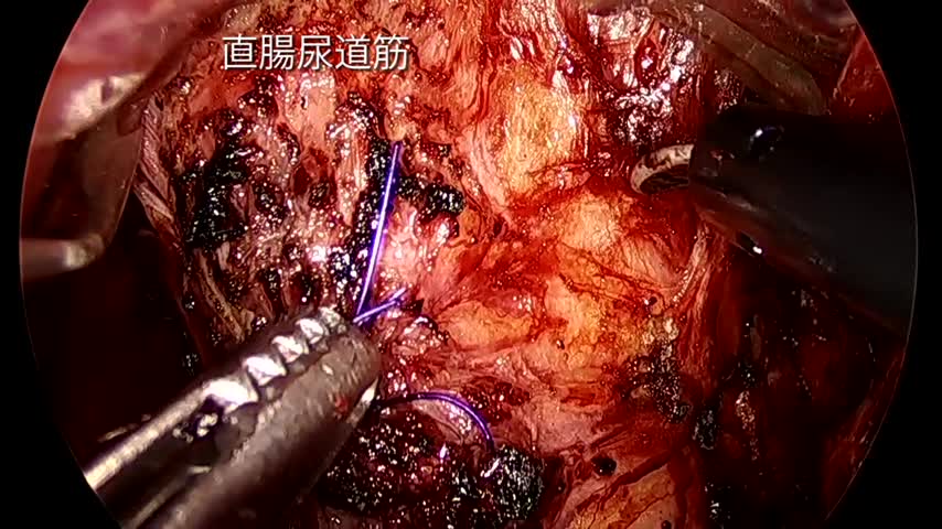 73-11-162岡田論文　図３，４　直腸尿道筋の切離...