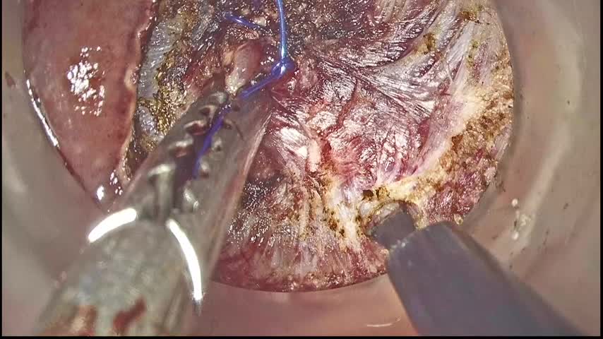 73-11-212加藤論文　図８   endopelvic fascia ...