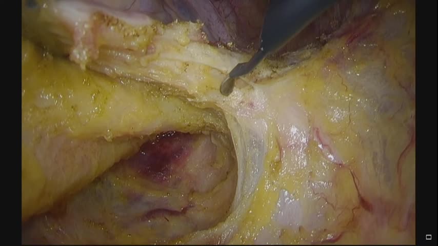 73-11-211加藤論文　図７　endopelvic fascia