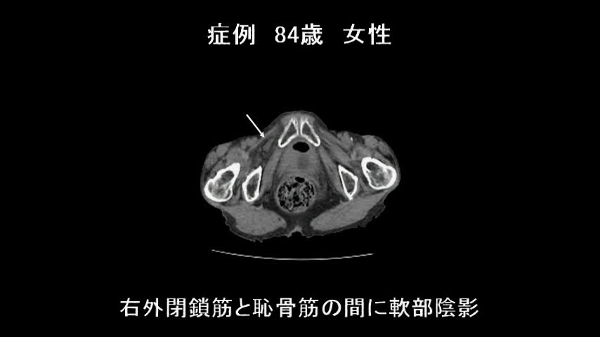 76-03蜂谷論文　閉鎖孔ヘルニア　図１