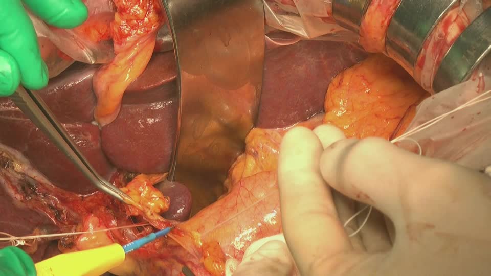 76-11-332貞森論文　動画２　肝十二指腸間膜内リンパ節郭清...
