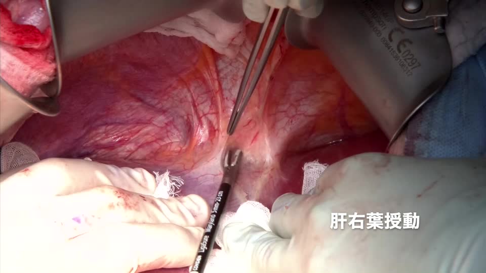 76-11-281板野論文　動画１　右葉授動