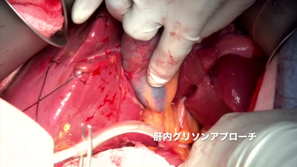 76-11-282板野論文　動画２　グリソンアプローチ...