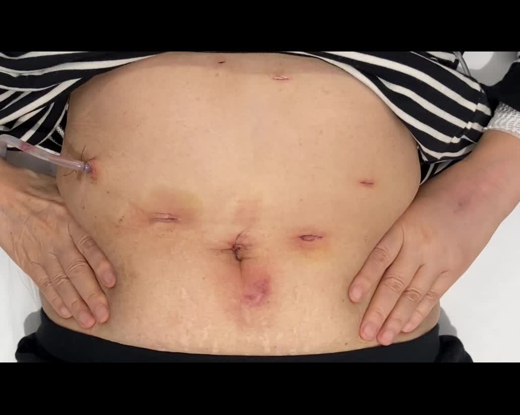 77-04FOCUS下山論文　動画１　両側側腹部圧迫法+腹腔鏡手術...