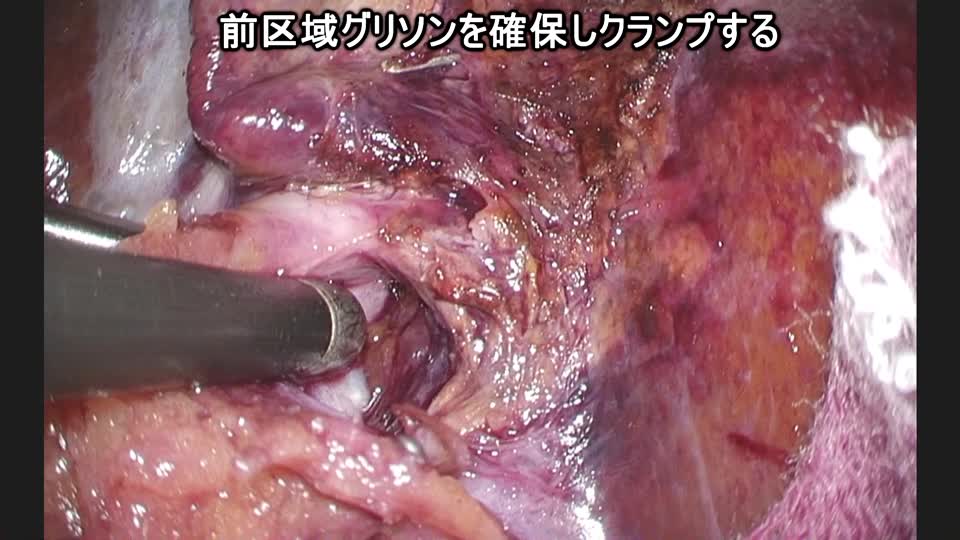 77-11-331門田論文　動画１　図2 paracaval portion...