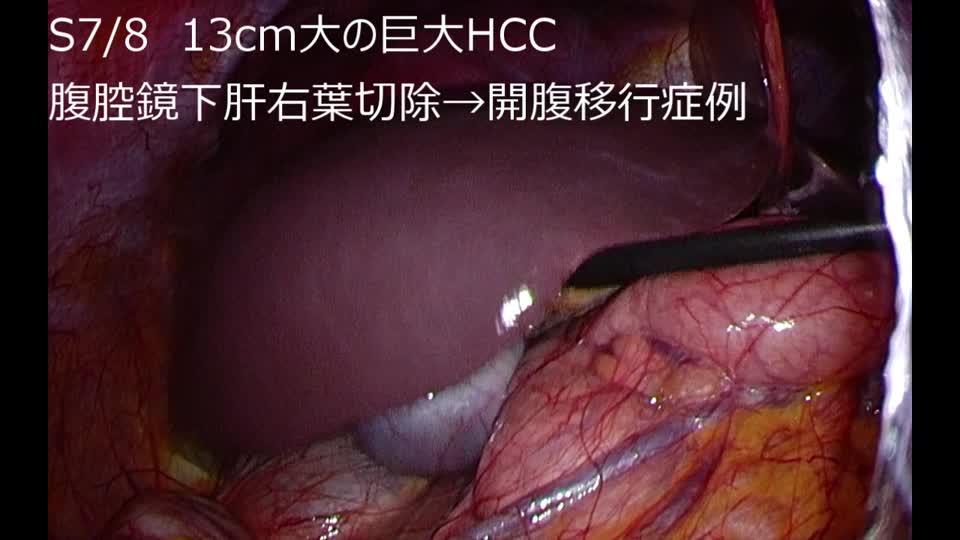 77-11-362西澤論文　Video2  図７　下横隔