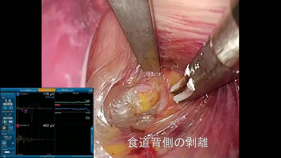 78-02-011塩崎論文　動画1