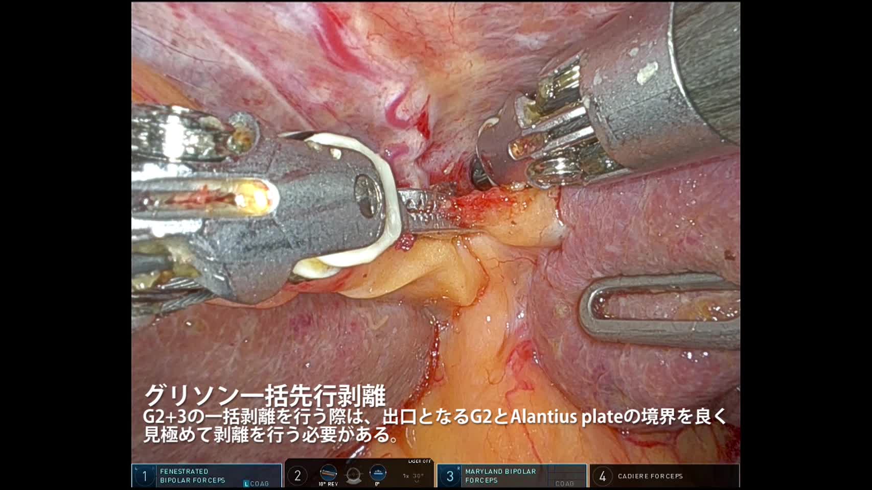 78-03-135森本論文　動画5図5