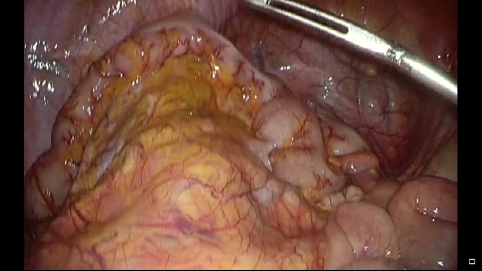 78-02-104野澤論文　動画４　症例4.横行結腸癒着症例...