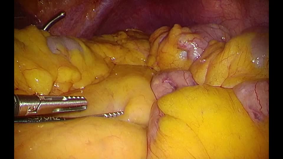 78-05-071太田論文　動画１　犠牲腸管作成...
