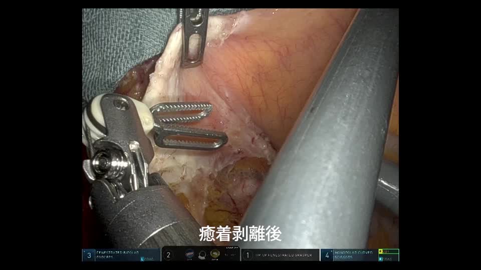 78-06-142花岡論文　動画２  図４　PDM困難症例内側アプローチ...