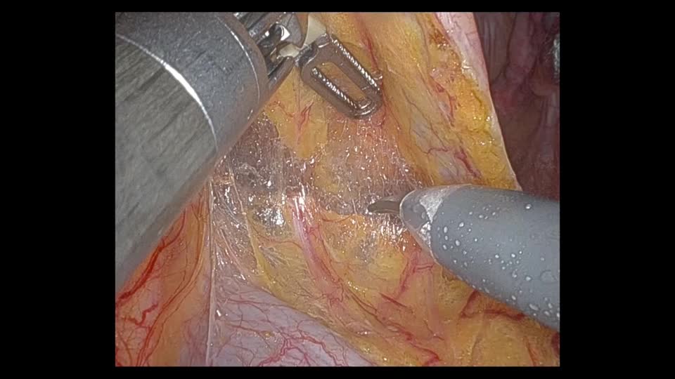 78-08-121笠井論文　動画1 　図３　直腸後壁授動...