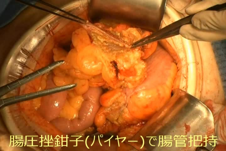 78-11-323小森論文　動画3　Albert-Lembert法...