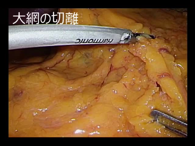 78-09-053室野論文　動画３　図８　脾彎曲の授動（頭側）...