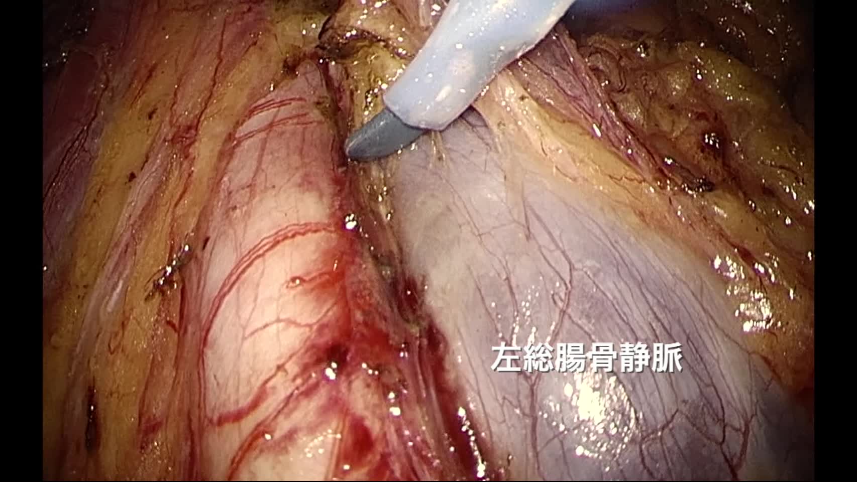 78-09-111村田論文　動画１　図３，４　腹腔鏡下TPEの腹部パートの具体的な手術手順...