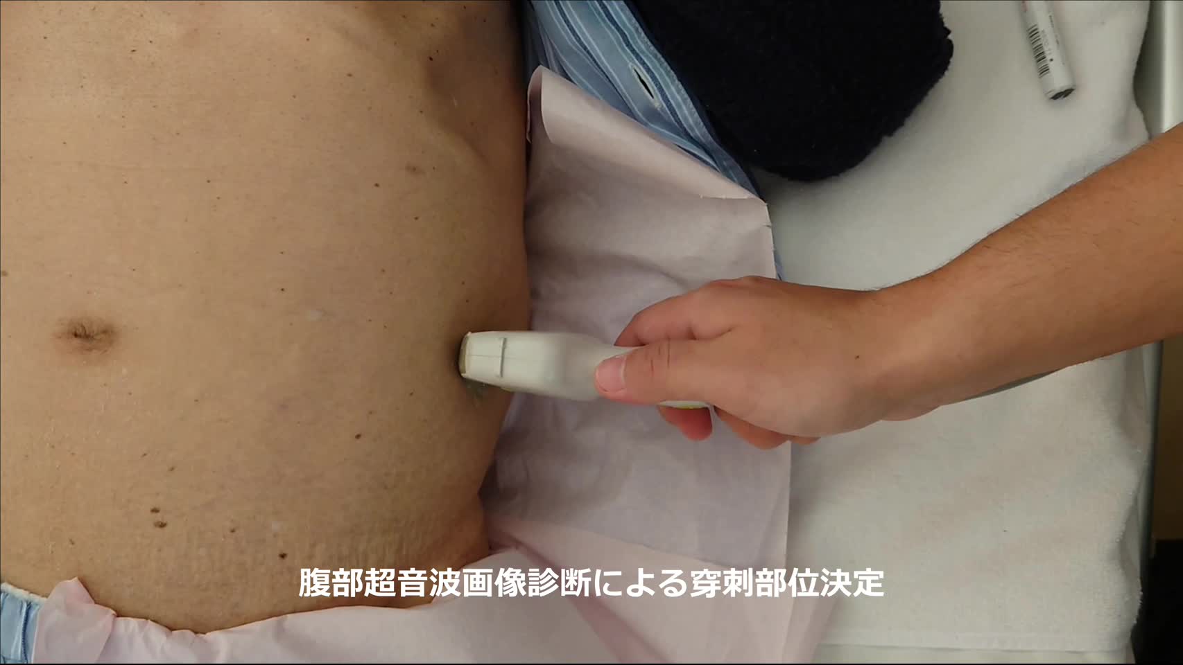 78-11-042大矢論文　動画2　図３　腹腔穿刺...
