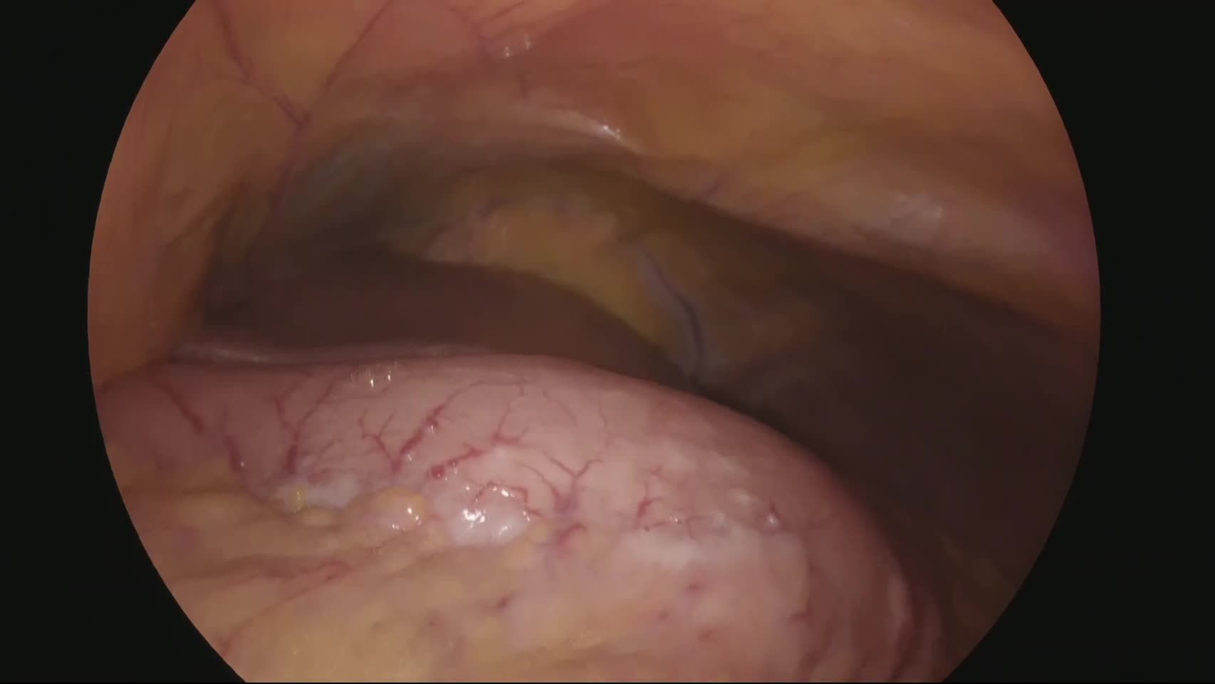 78-11-101小林論文　動画1　図３　壁側腹膜，細胞診...