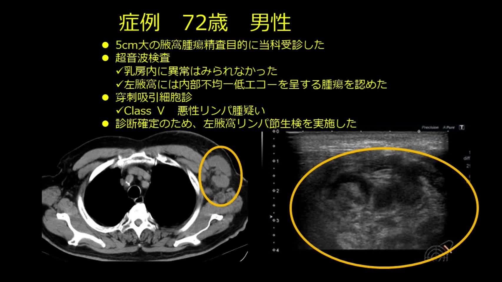 78-11-201丹羽論文　動画1　症例