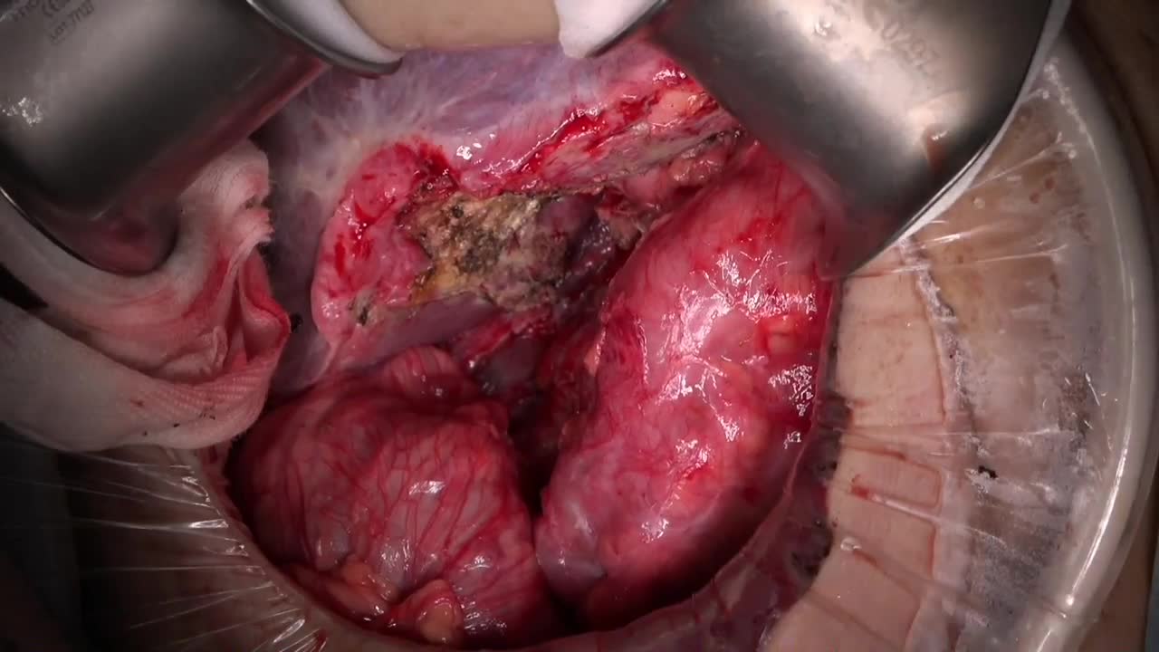 78-11-462上村論文　動画2　図6,7  総胆管切開から結石除去...