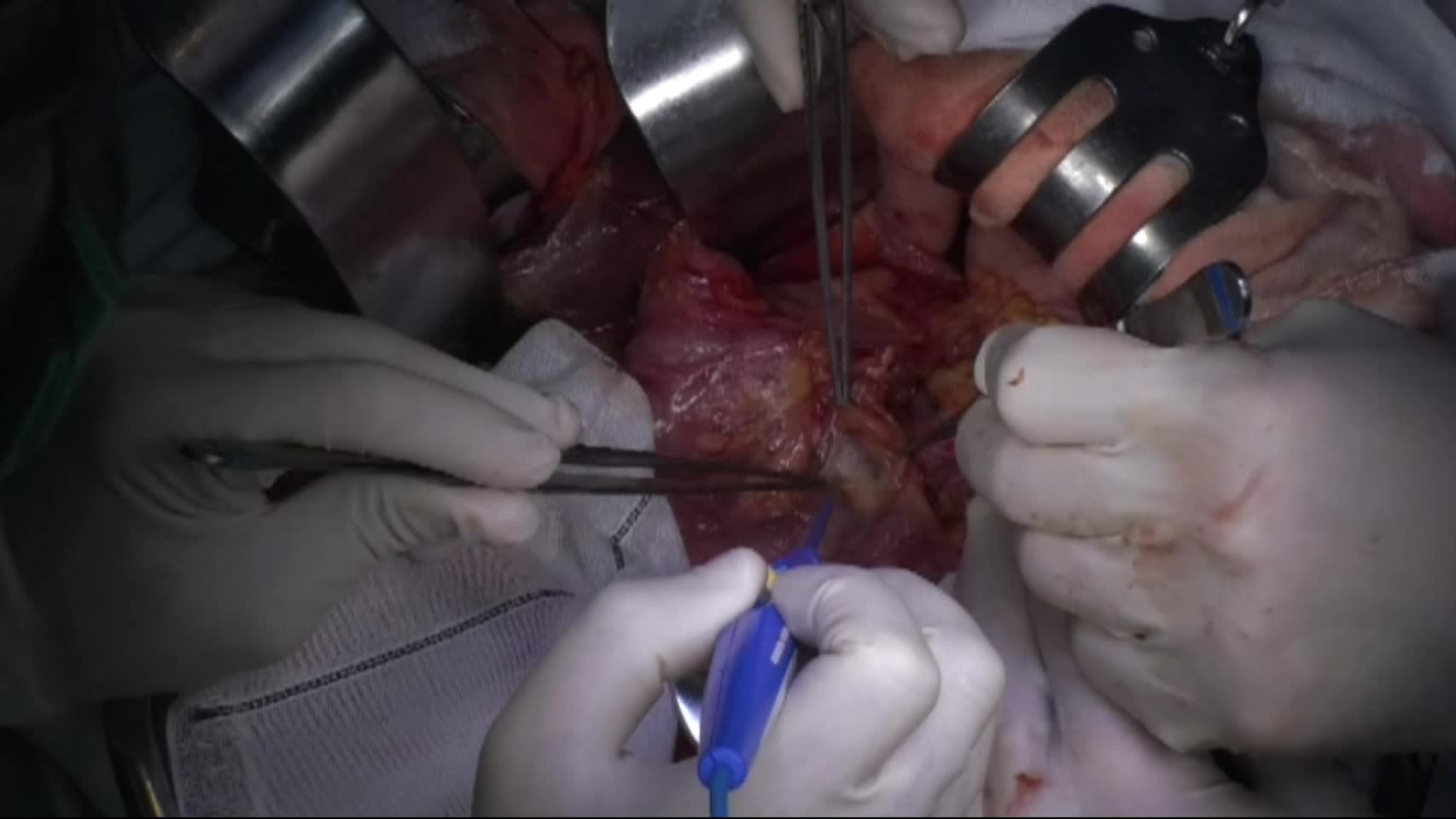 79-04-091　動画１  手術手技[1]～[6], 図1,2 ...
