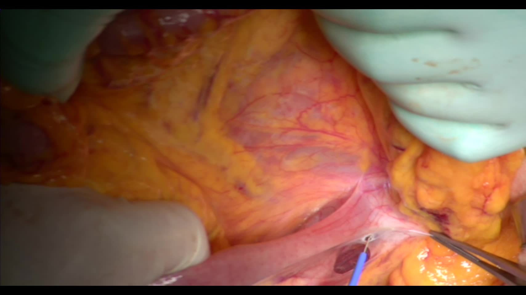 79-04-08　動画１　図3～11　mesenteric approach　...