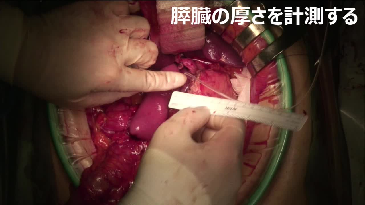79-04-122　動画２　図３,  吻合部のデザイン...
