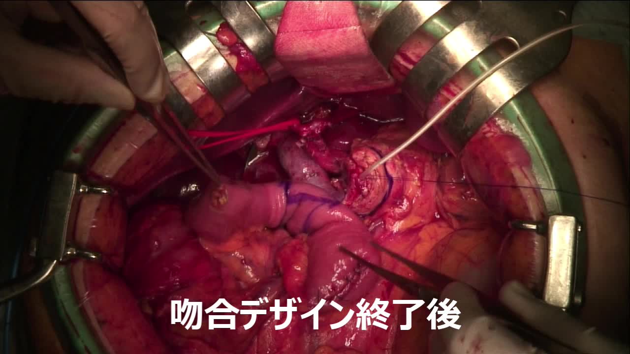 79-04-123　動画３　膵管吻合孔の作成