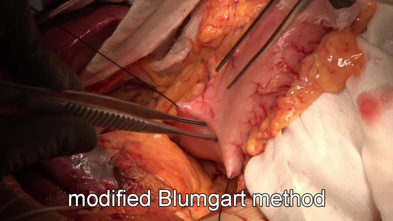 79-04-131　動画１　図４　modified Blumgart method...
