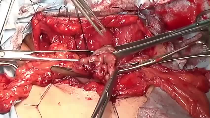 79-08-073　動画3　図３　三角吻合