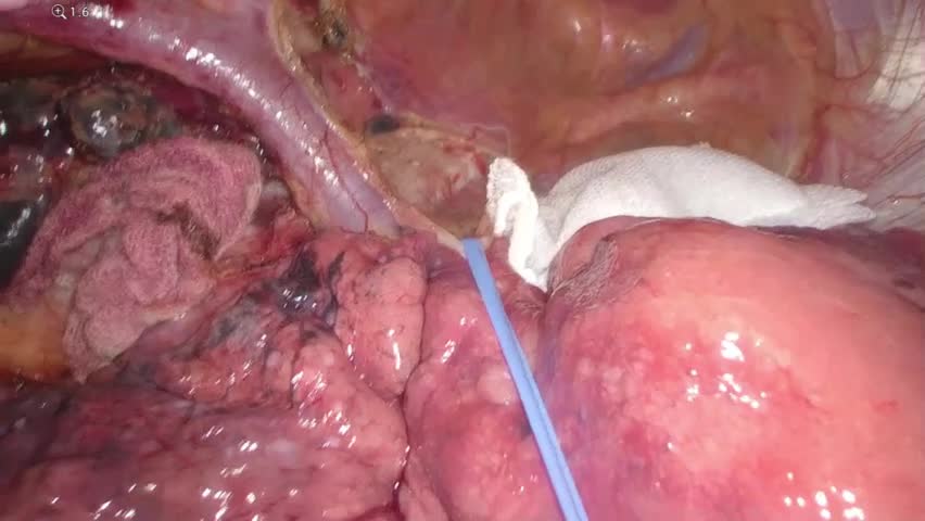 79-08-071　動画1　図１　右上縦隔郭清