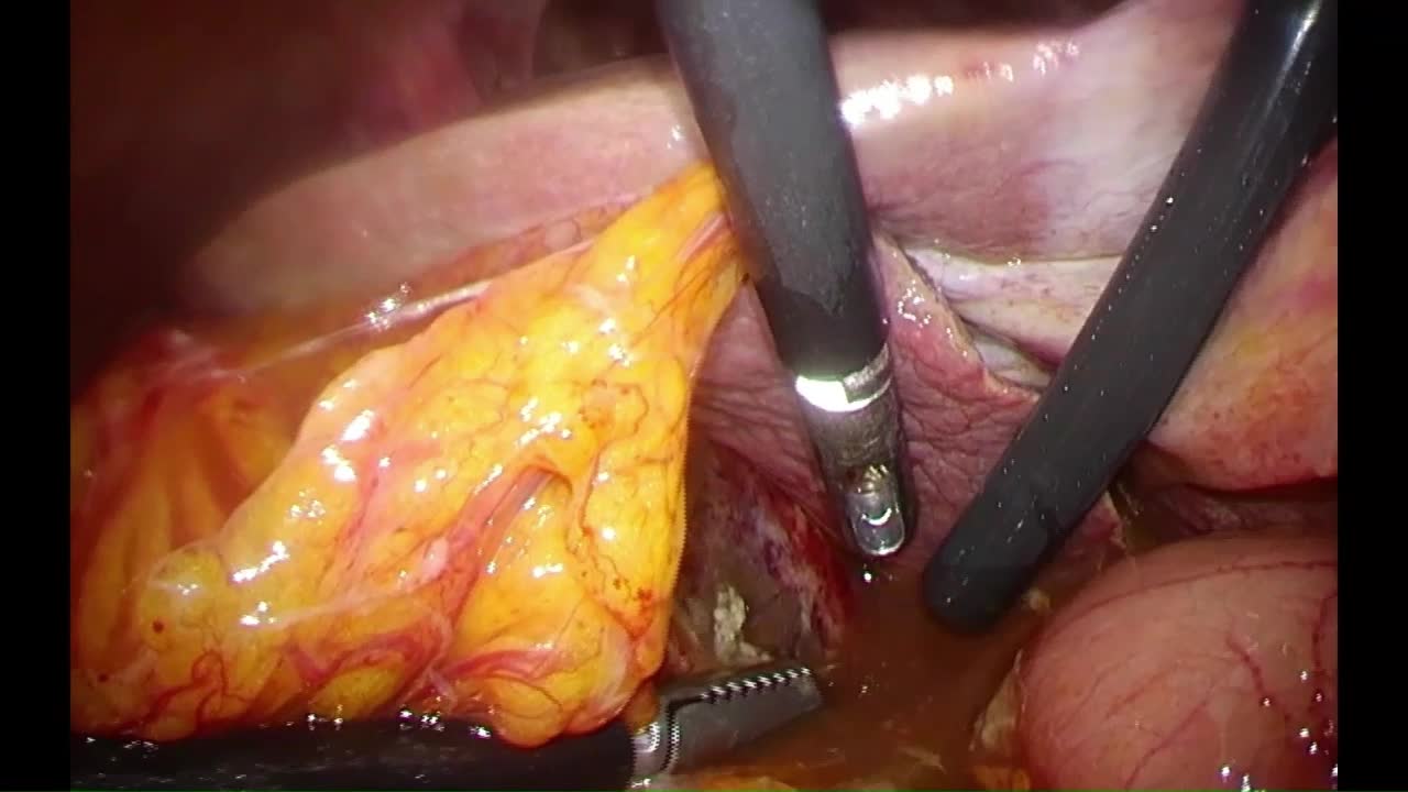 79-11-331　浅井論文　動画1　図１  Fundus first technique...