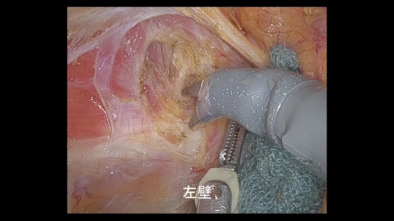79-11-232笠井論文　動画2  図２　肛門挙筋切離...