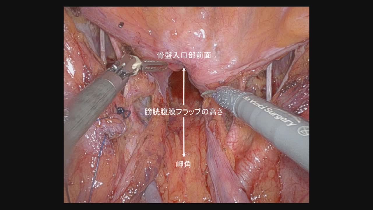 79-11-233笠井論文　動画3  図４　膀胱腹膜フラップ...