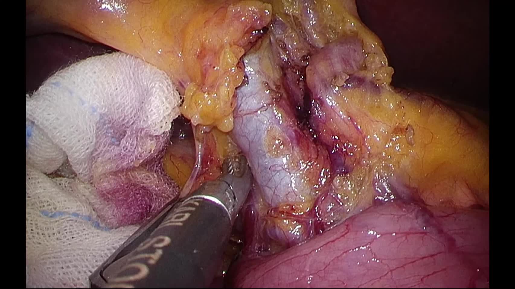79-11-342大目論文　動画2　図２　門脈周囲の剥離...