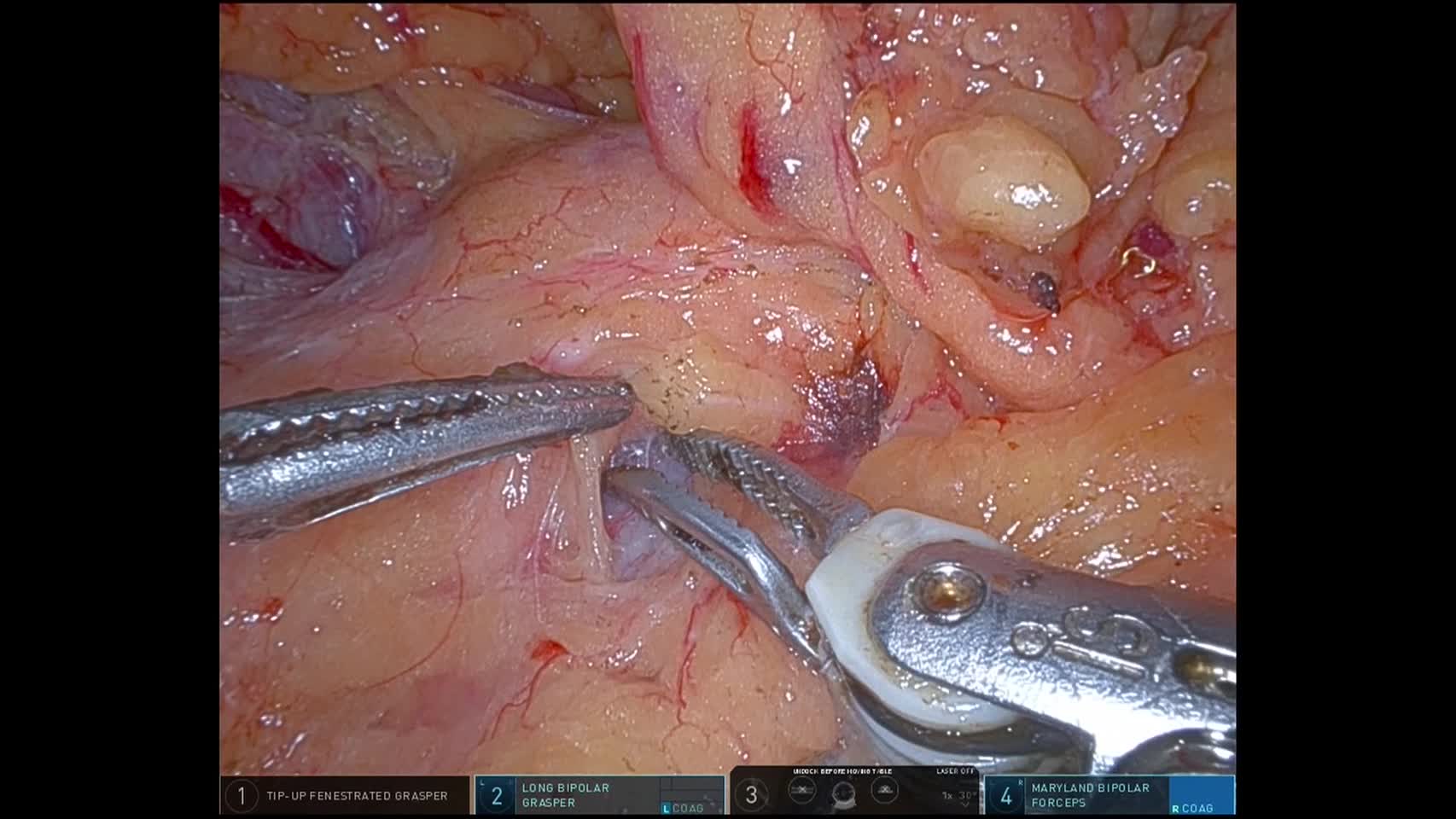 79-11-362木谷論文　動画２　図2e～g   anterior-right  ...