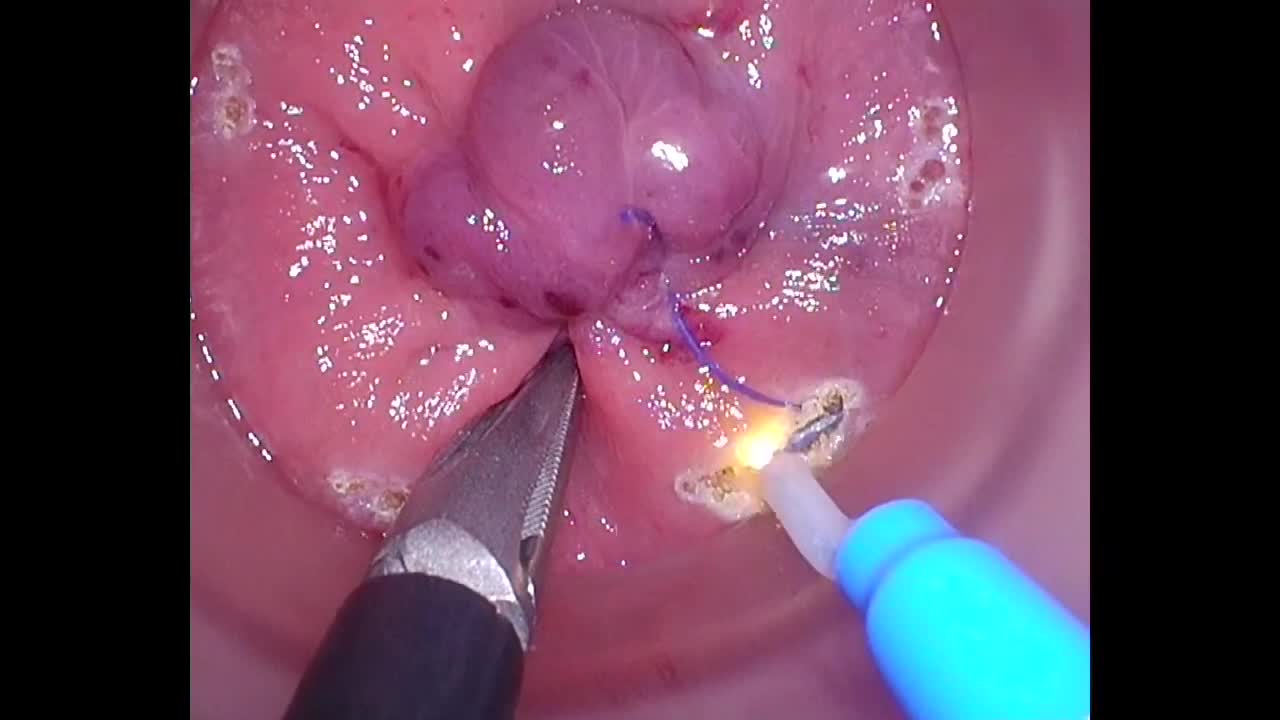 79-11-171_動画1_図2_Rectotomy