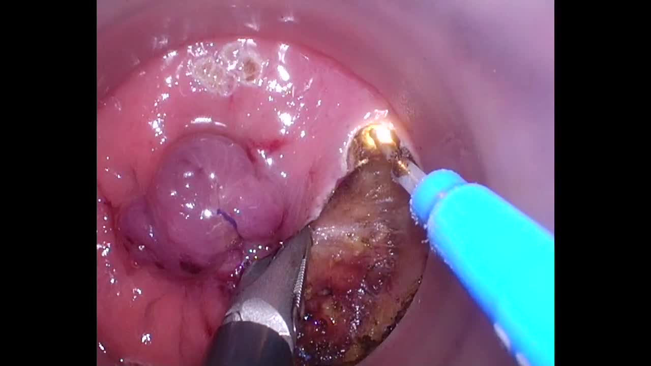 79-11-172_動画2_図3_前立腺の確認