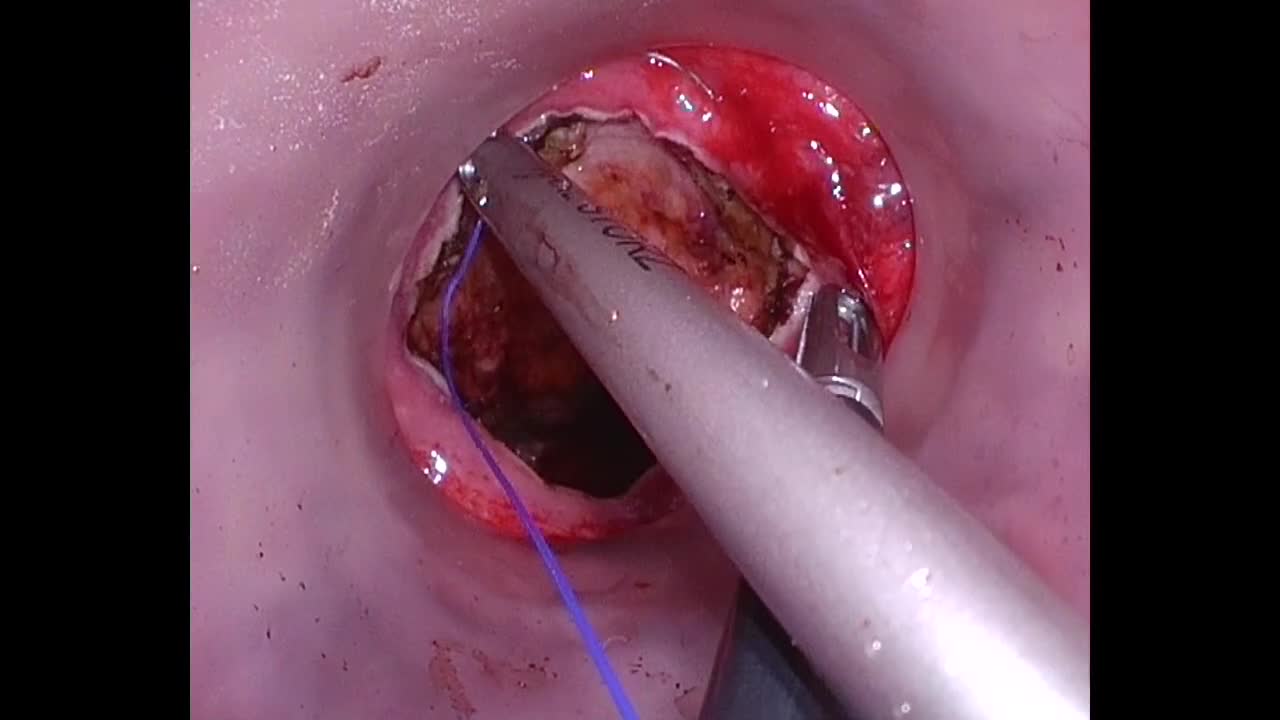 79-11-174_動画4_図6_distal suture