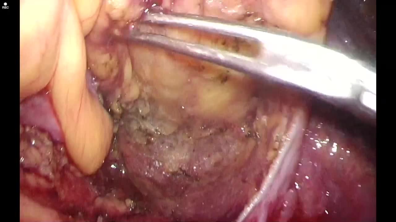79-11-221_動画1_図2_Lap-IACA_直腸背側
