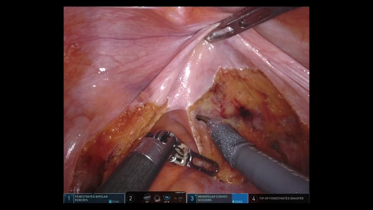 79-11-222_動画2_図3_Robot-IAA_直腸前壁DVF