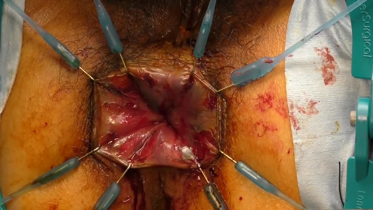 79-11-224_動画4_図6_IAA粘膜抜去