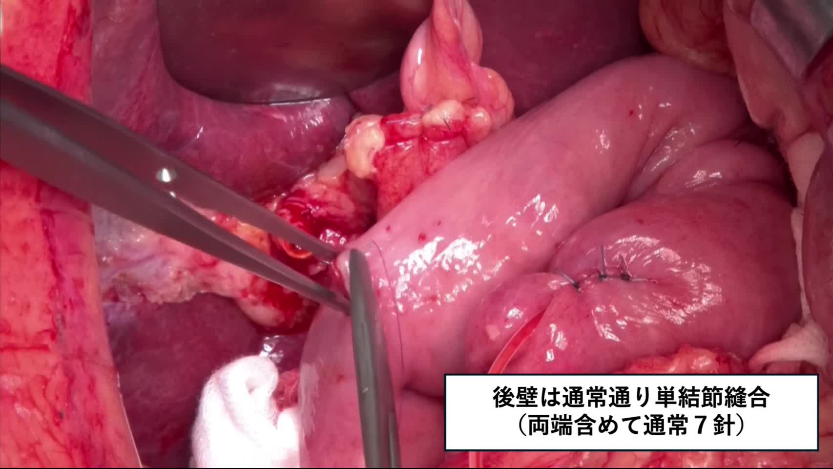 80-01-101古原論文_動画1_T吻合