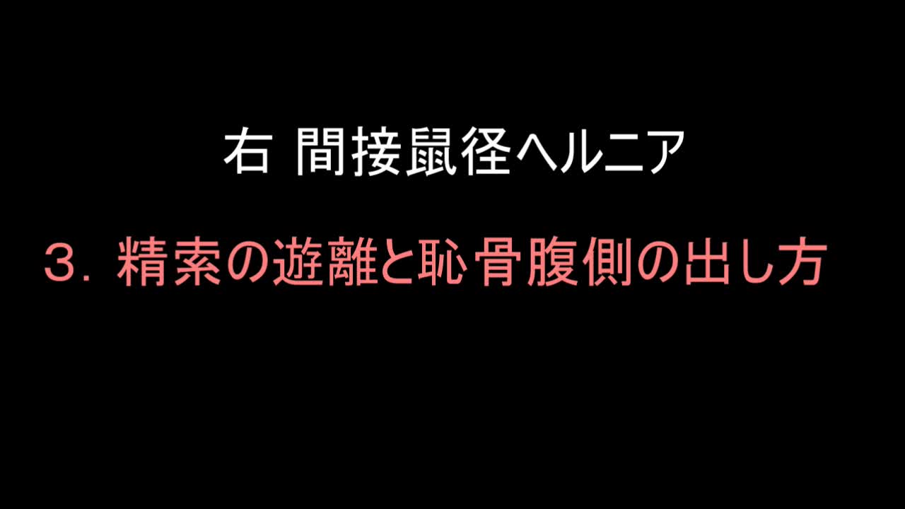 79-11-413三澤論文　動画3 　図５　精索の遊離と恥骨腹側の出し方...