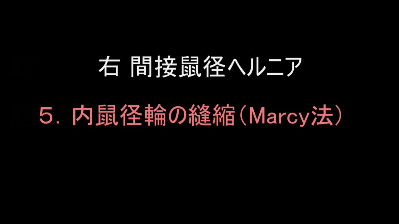79-11-415三澤論文　動画5   図８　内鼠径輪の縫縮（Marcy法）...