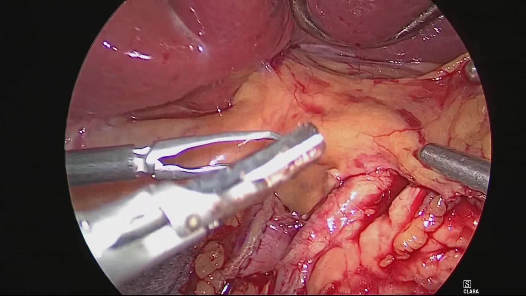 79-13-043動画3  膵上縁  不合格 Before