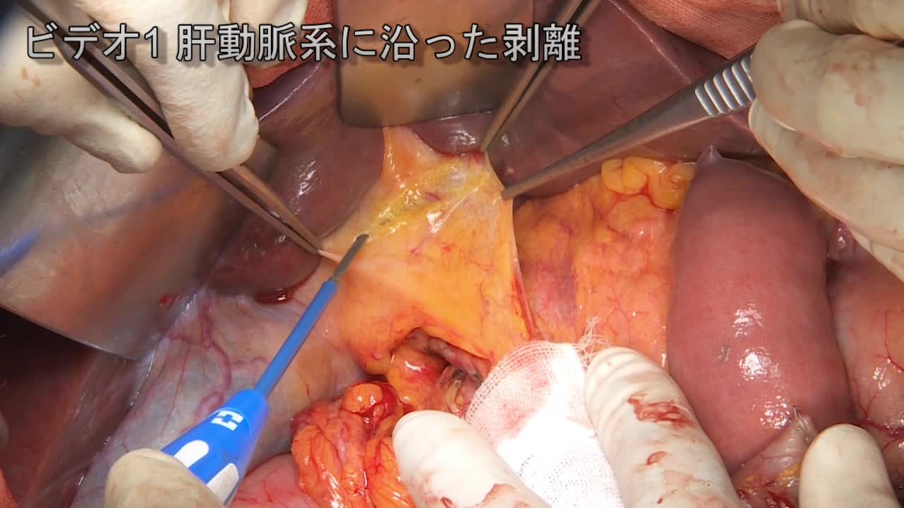 79-11-351井上論文　動画１　肝動脈系に沿った剥離...