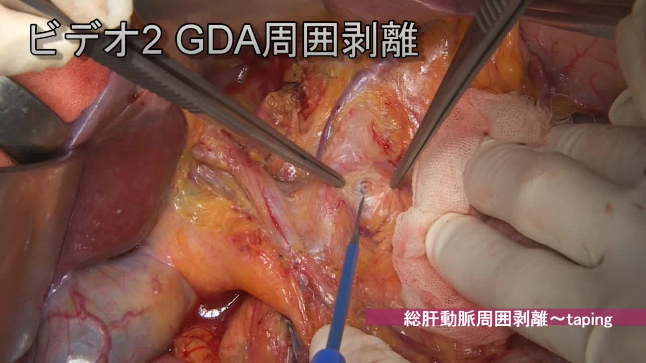 79-11-352井上論文　動画2　 GDA周囲剥離