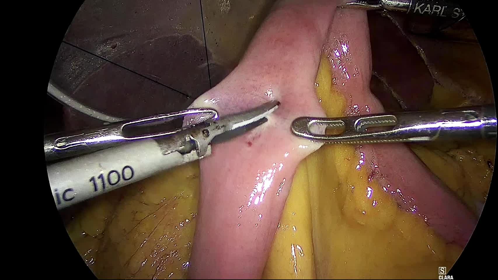 80-01-061林論文_動画1_図2_BillrothⅡ法