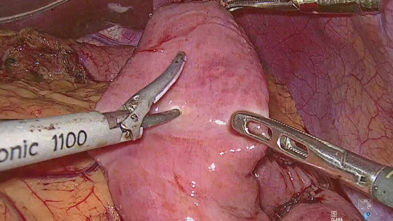 80-01-063林論文_動画3_図5_Roux-en-Y法：残胃空腸再建...