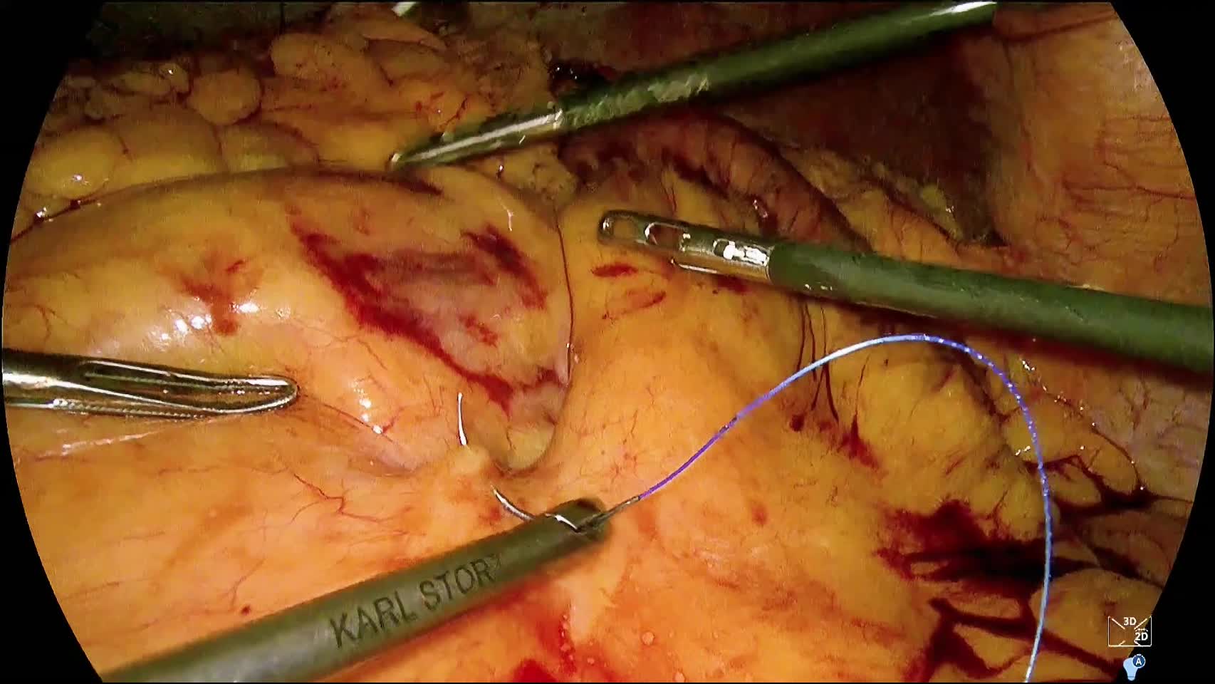 80-01-064林論文_動画4_図6_Roux-en-Y法：Petersen’s spaceとY脚...